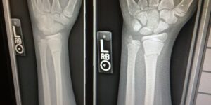 Röntgenbild von einer Hand