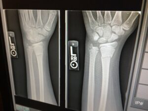 Röntgenbild von einer Hand